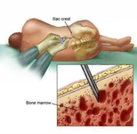 Kemik İliği Biyopsisi Özellikleri ve Faydaları Nelerdir?