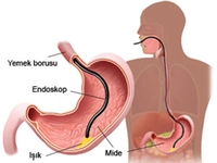 Mide Biyopsisi Kimlere Uygulanır?