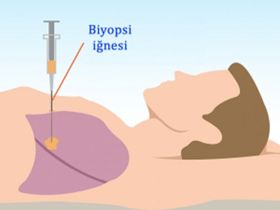 Akciğer Biyopsisi