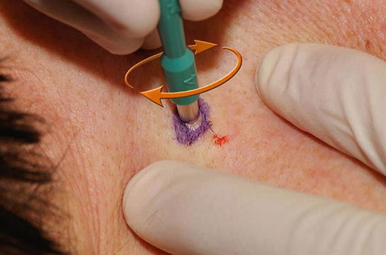 Biyopsi Nedir ve Nasıl Yapılır?