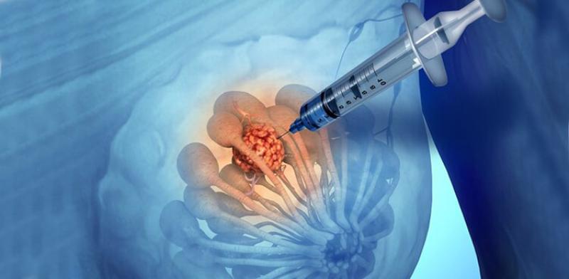 Böbrek Biyopsisi Nedir ve Nasıl Yapılır?