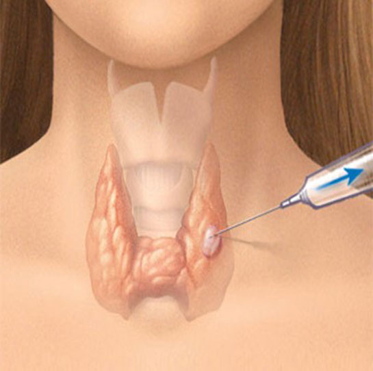 Boğaz Biyopsi Özellikleri ve Faydaları Nelerdir?