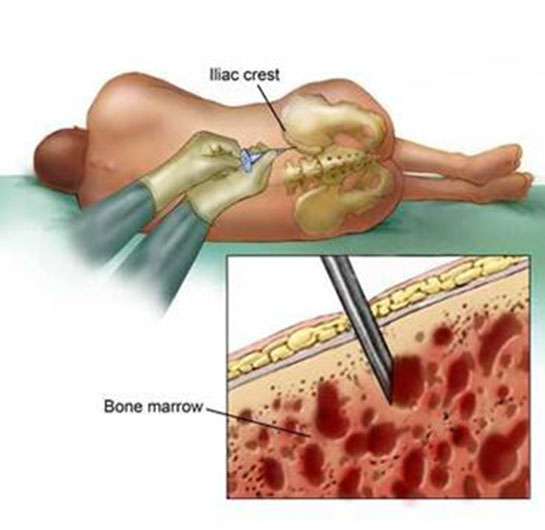 Kemik İliği Biyopsisi Özellikleri ve Faydaları Nelerdir?