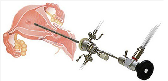 Küretaj Biyopsi Nedir ve Nasıl Yapılır?