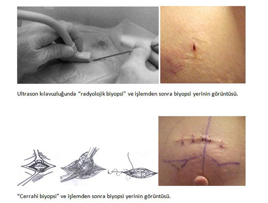 Meme Biyopsisi Özellikleri ve Faydaları Nelerdir?