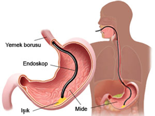 Mide Biyopsisi Kimlere Uygulanır?