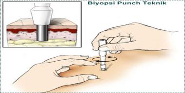 Eksizyonel Biyopsi, Özellikleri ve Faydaları Eksizyonel Biyopsi