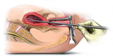 Endometrial Biyopsi, Özellikleri ve Faydaları Endometrial Biyopsi