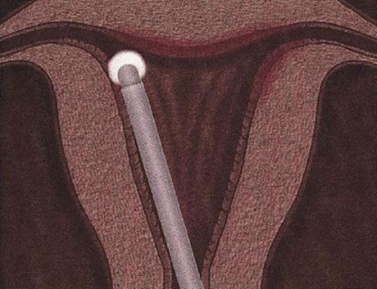 Rahim Biyopsi Nedir ve Nasıl Yapılır?