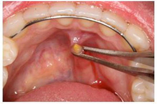 Tükürük Bezi Biyopsisi Özellikleri ve Faydaları Nelerdir?